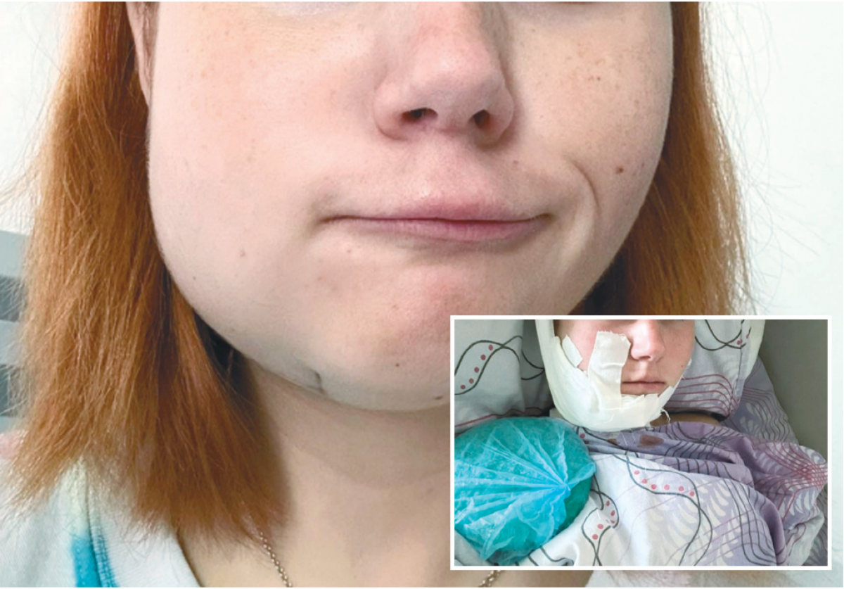    Опухоль, с которой девушка поступила в московскую клинику, и фото после операции.