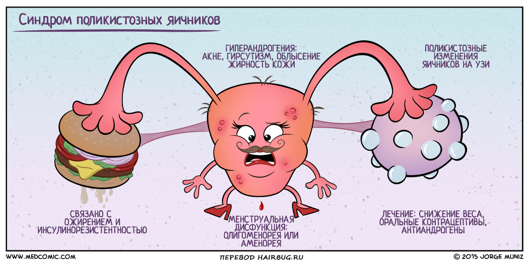 Чем лечить поликистоз яичников и выпадение волос