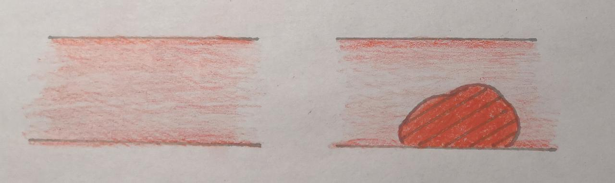 Норма/Сосуд с атеросклеротической бляшкой (АСБ)