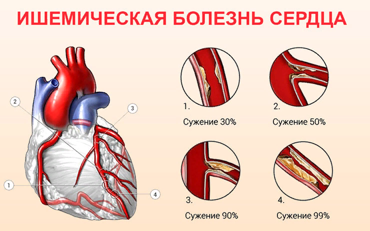 http://www.medicbest.ru/images/Ishemicheskaya-bolezn-serdtsa.jpg