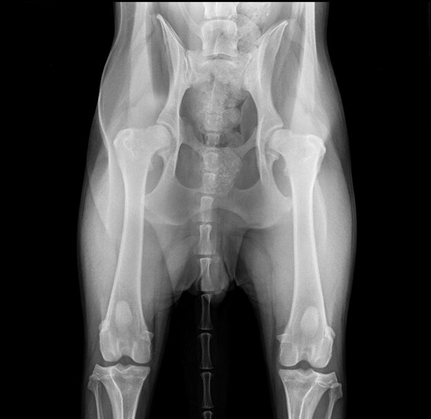  Дисплазия ТБС