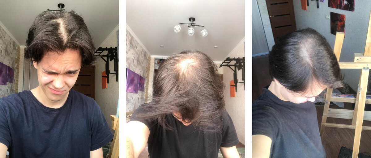 Появился заметный пробор посередине и просвет на затылке. Со временем начали появляться островки