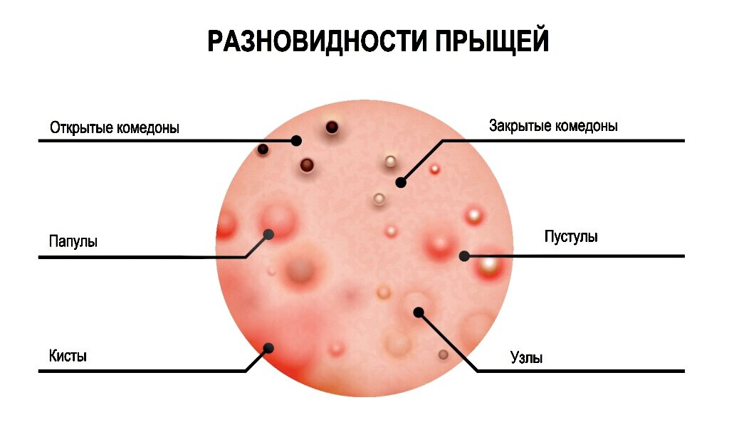 От тортов появляются прыщи