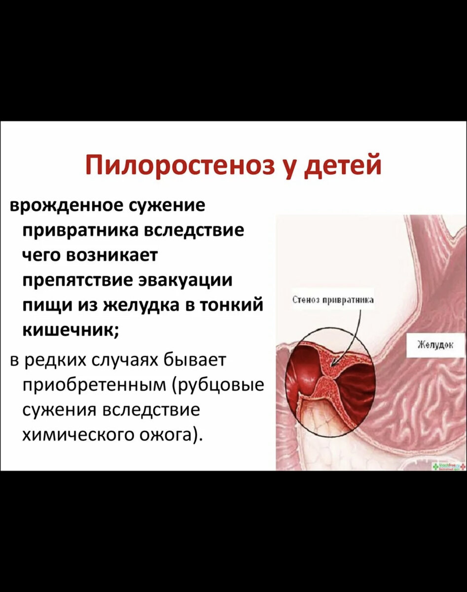 Что такое привратник. Врожденный гипертрофический пилоростеноз. Основные клинические симптомы пилоростеноза у новорожденных. Стеноз привратник желудка этиология. Пилоростеноз у детей презентация.