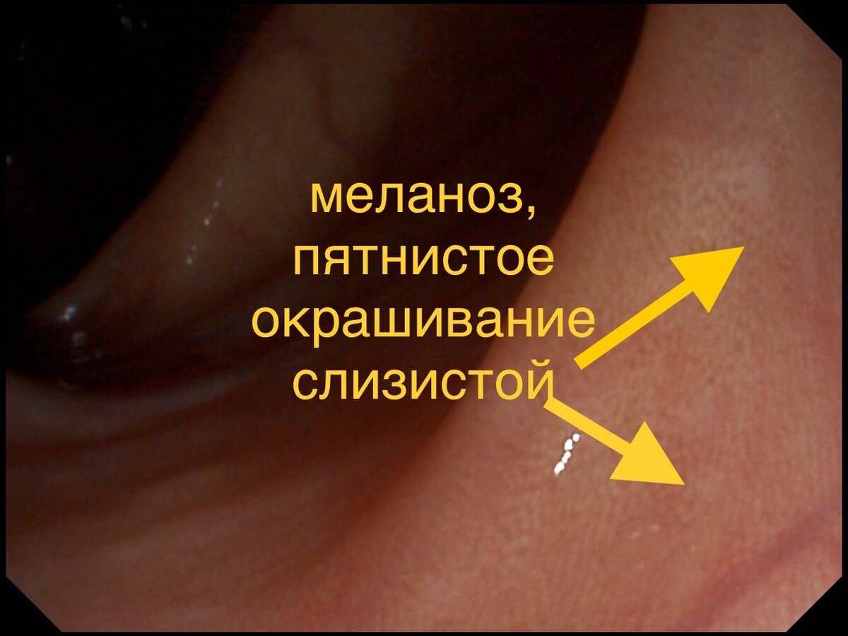 Фото из личного архива. Слизистая кишечника с проявлением меланоза 