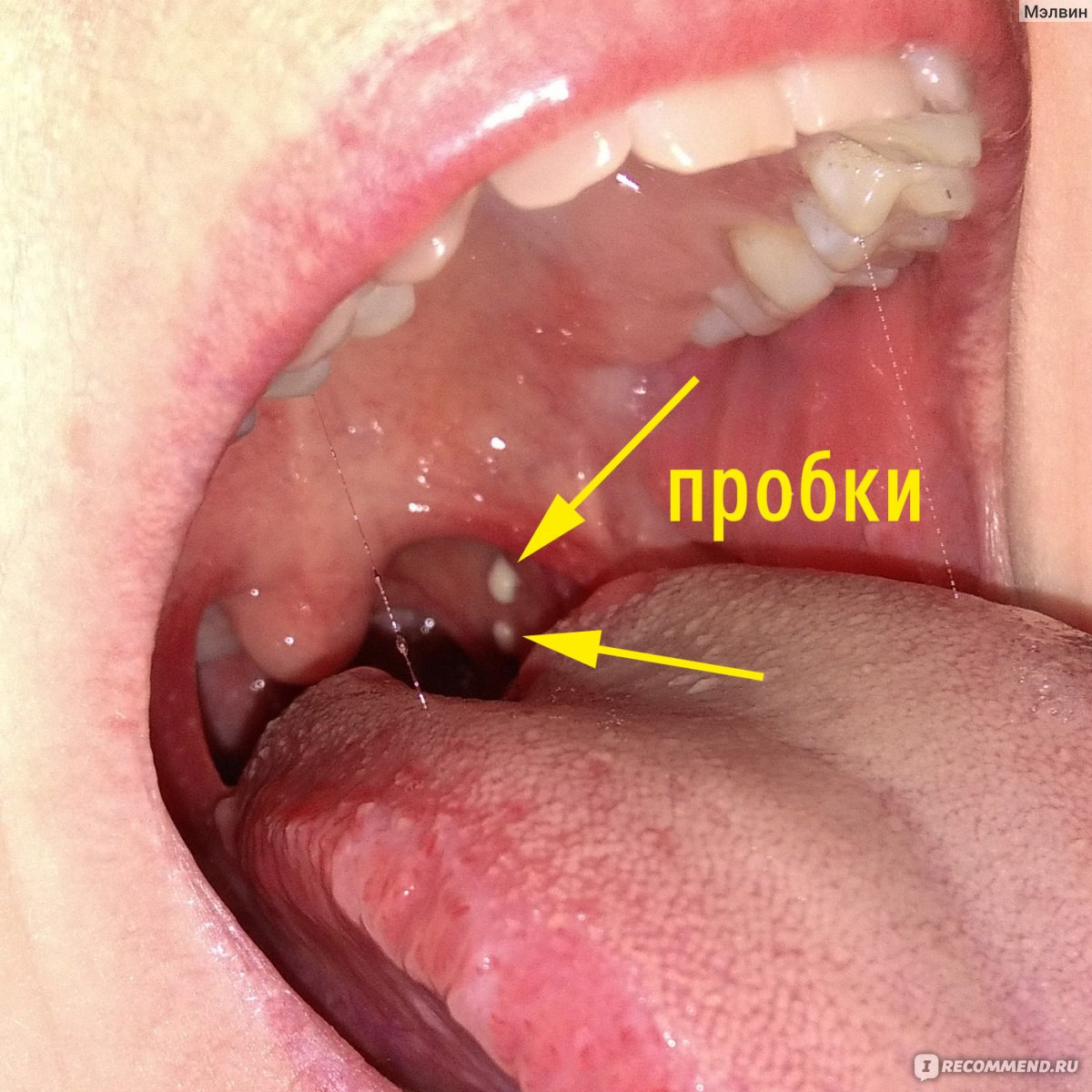 Хронический тонзиллит