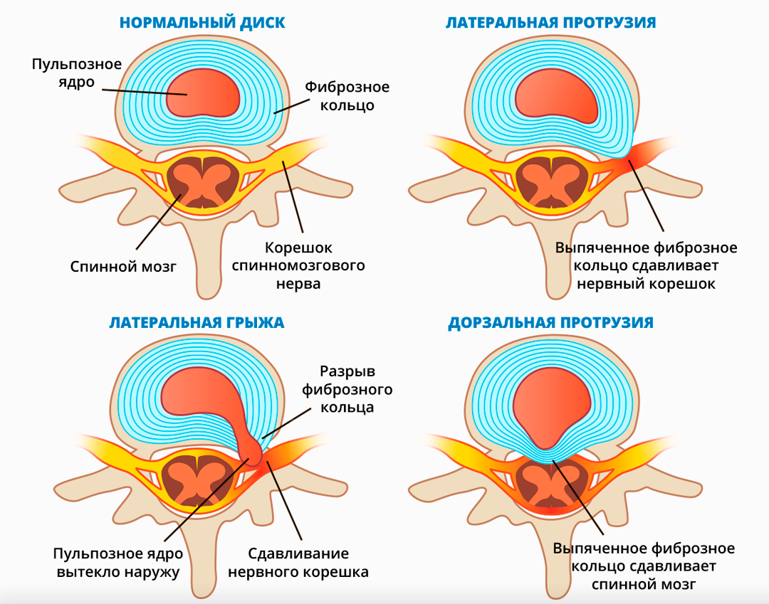 Межпозвоночная грыжа