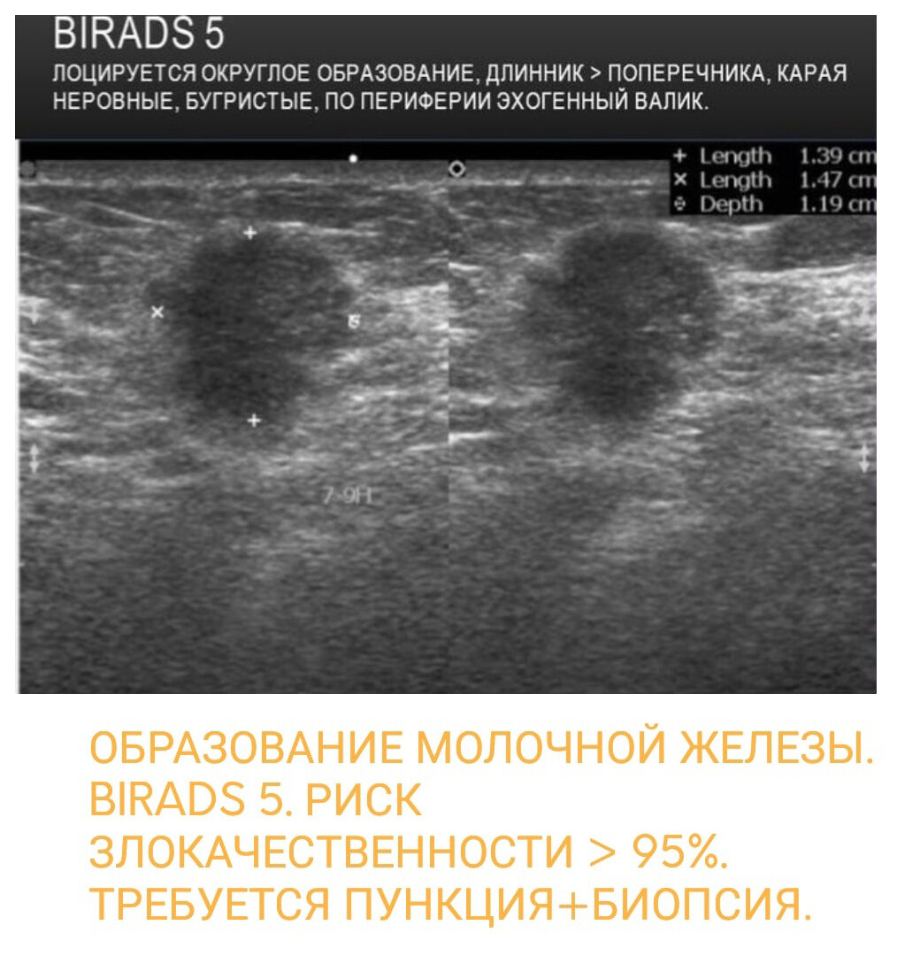 Система BI-RADS для УЗИ: описание, классификация, иллюстрации