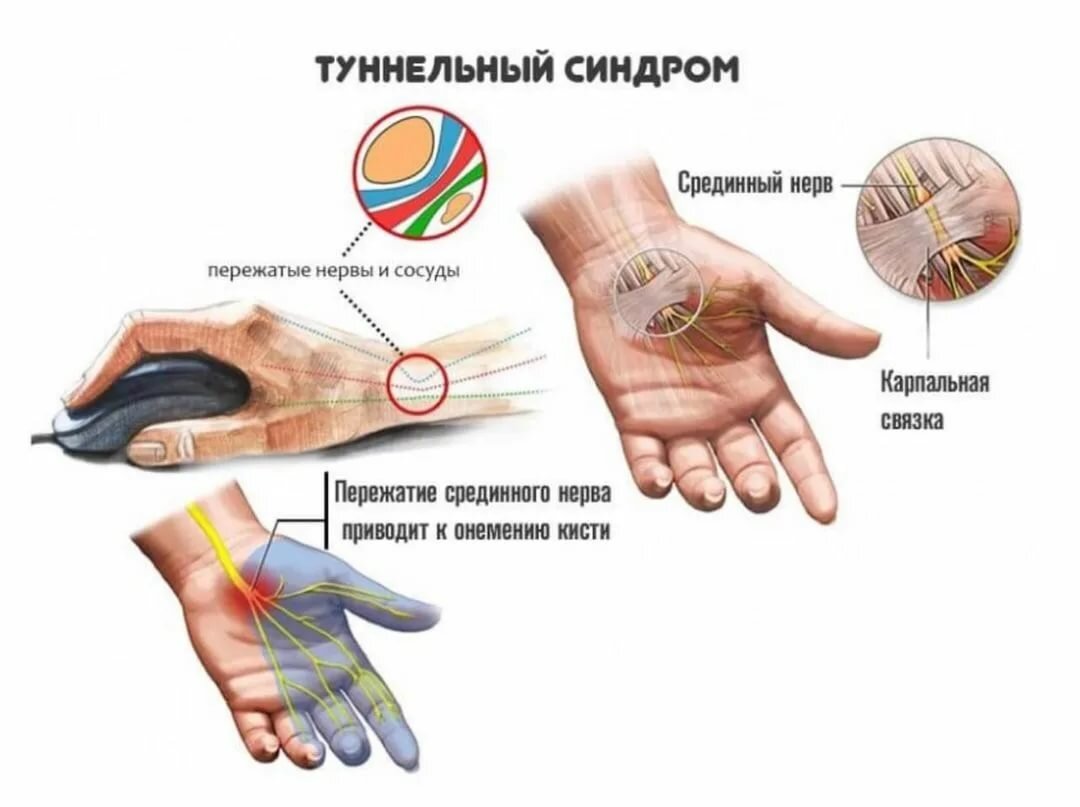 Диагностика и лечение туннельного синдрома (Сергиев Посад)