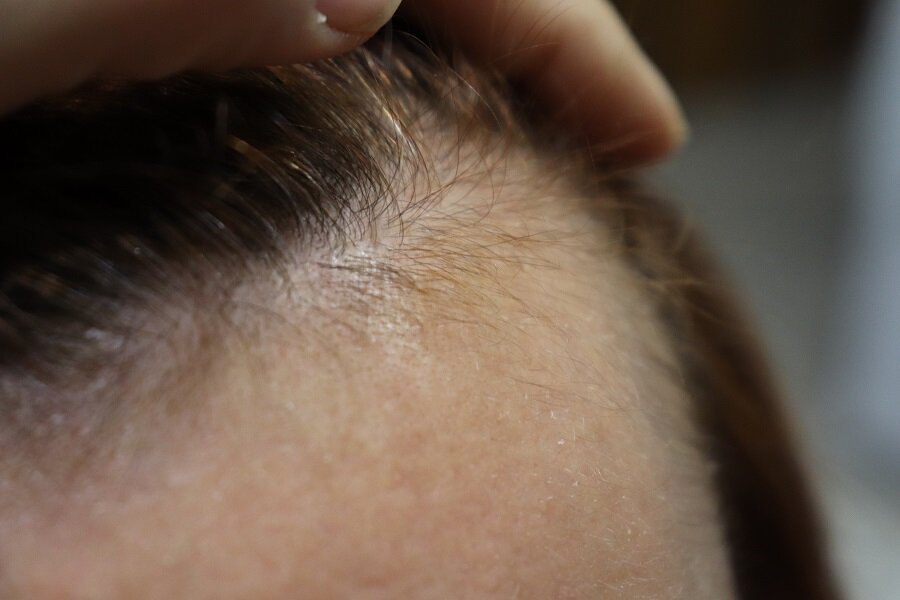 Пересадка волос для женщин в Москве, цены. Трансплантация волос на голове у женщин, фото, отзывы