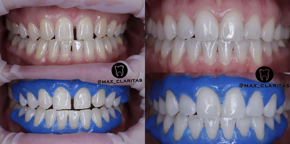 Большинство взрослых людей утрачивают белоснежный оттенок зубов с возрастом. Виной тому продукты с пищевыми красителями, напитки, курение, употребление лекарств. Революционное отбеливание зубов ZOOM 4 ( зум 4) легко исправит ситуацию, устранив непривлекательную желтизну с поверхности ваших зубов. Один визит в стоматологию, и вы перестанете испытывать неловкость при общении с другими людьми. Процедура уберет пятна и потемнения с эмали. Поверьте, после нее привлекательная улыбка станет вашим главным оружием.