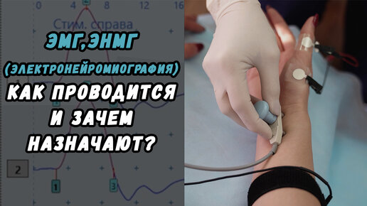 Эмг сделать. Электромиография Хабаровск. Как делается ЭНМГ верхних конечностей. ЭНМГ синдром карпального канала