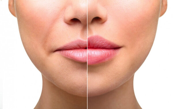 Настоящую консультацию можно получить исключительно во время беседы с лечащим врачом. Дополнительная коррекция может быть востребована (или нет) через месяц после всех процедур. 
