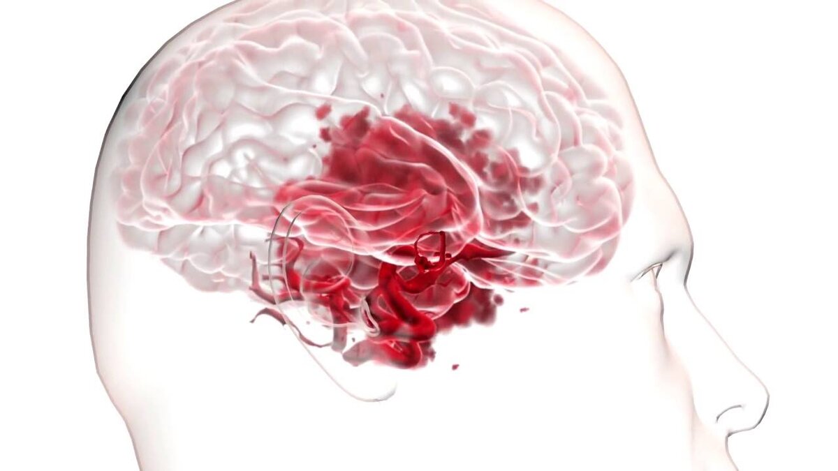 Аневризма головного мозга - просто о сложном | Нервы в порядке | Дзен