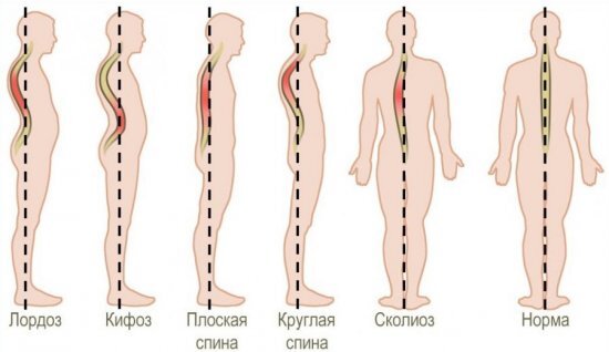 Основные типы осанки