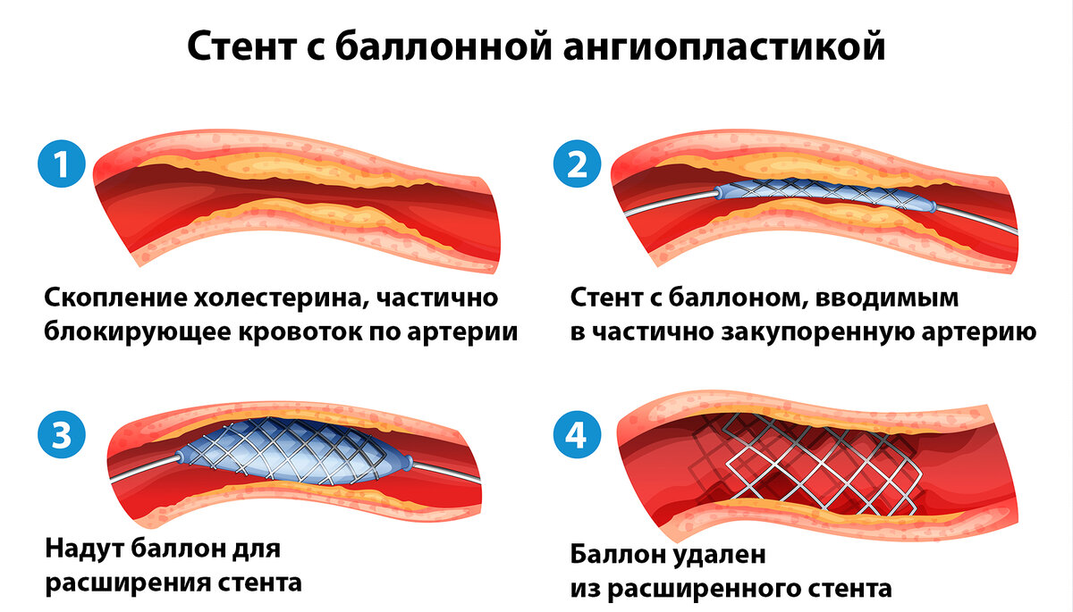 Стентирование сердца что это такое