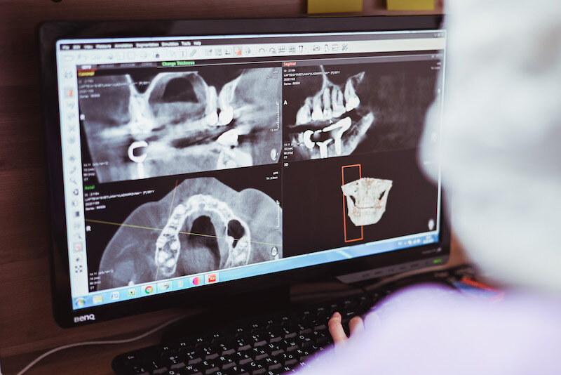 Компьютерная томография для ЛОРа или проводимая перед имплантацией или протезированием основана на тех же принципах.