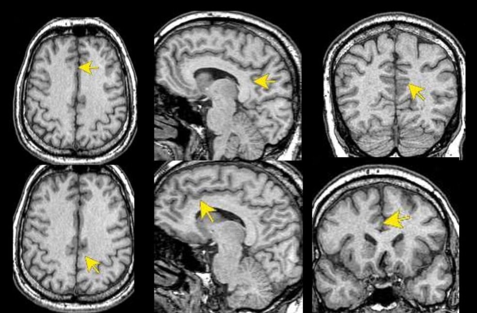 Часть головного мозга, расположенная в медиобазальной части коры больших полушарий, непосредственно над мозолистым телом, является частью поясной коры — поясная извилина.