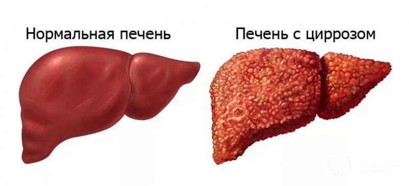 Когда печень еще борется с развитием цирроза - печень увеличивается. Как бы "разбухает". При терминальной стадии цирроза печень "сжимается". Фото взято с источника: https://tamc.co.il/article/tsirroz-pecheni/