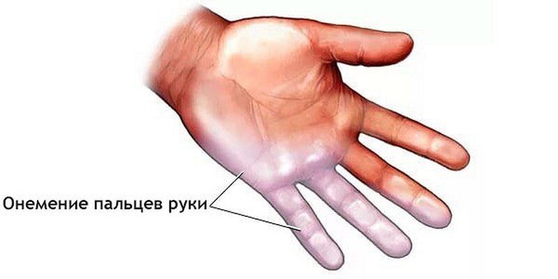 Почему немеют пальцы рук: причины и лечение — Клиника профессора Кинзерского в Челябинске