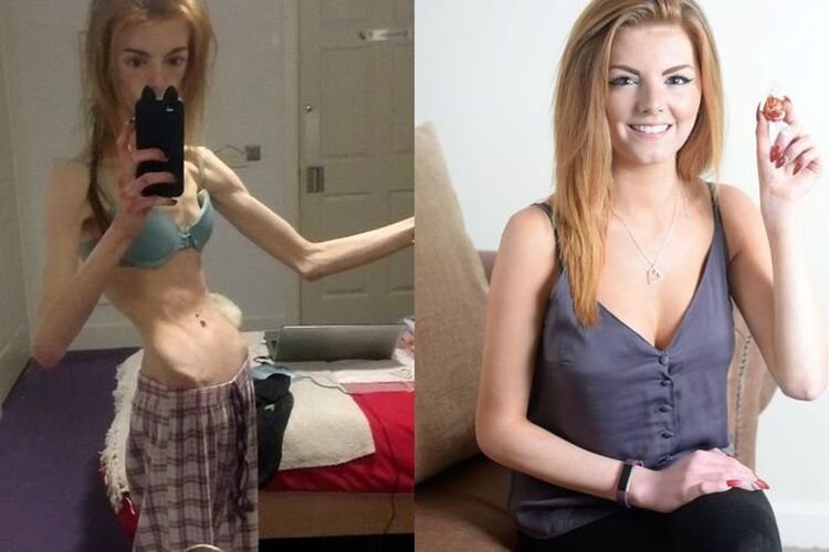 Энни во время и после болезни