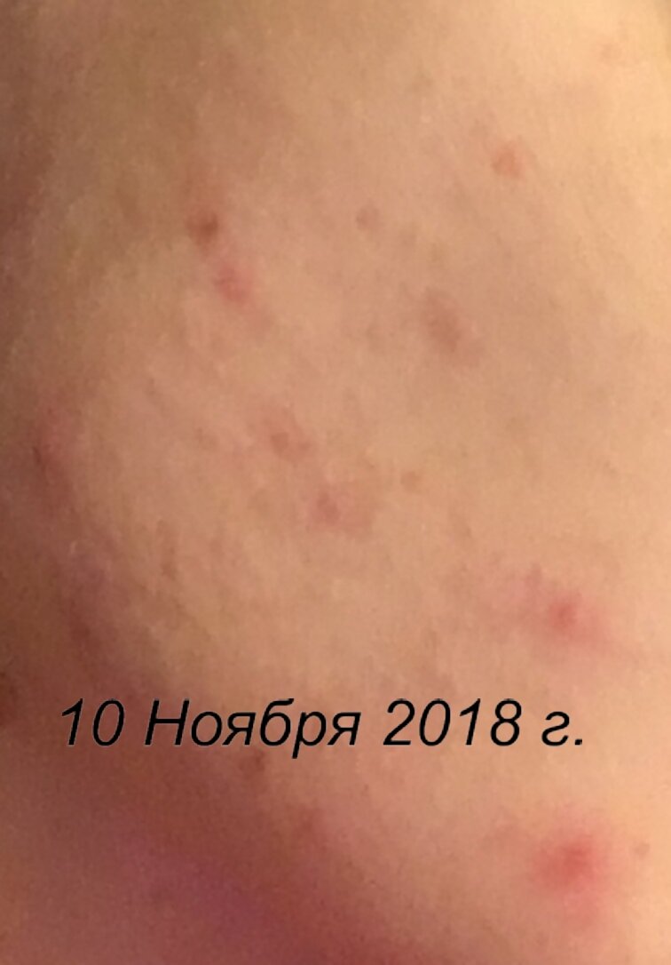 прыщи на лице закрытые комедоны