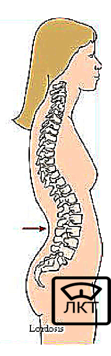 Лордоз, лечение, улучшение 