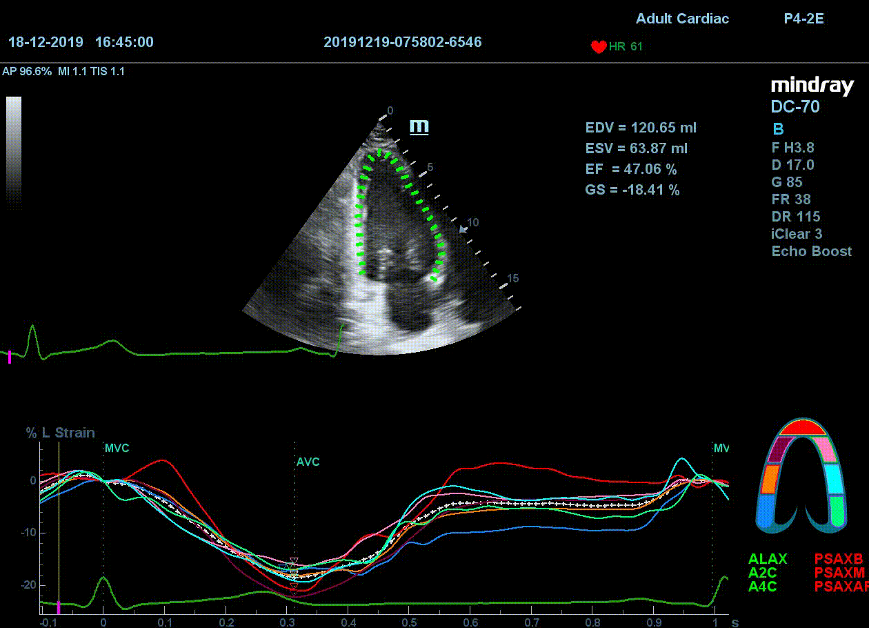 Технология Speckle-tracking на УЗИ аппарате DC-70 Pro X-Insight