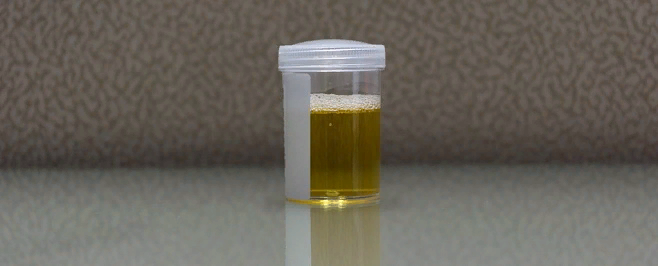 61-летняя женщина с поражением печени и некомпенсированным сахарным диабетом обратилась в госпиталь Питтсбургского университета для постановки в очередь на пересадку печени. Ранее врачи подозревали, что ее проблемы со здоровьем могли быть связаны с зависимостью от алкоголя, поскольку анализы мочи регулярно показывали превышение допустимого уровня алкоголя.