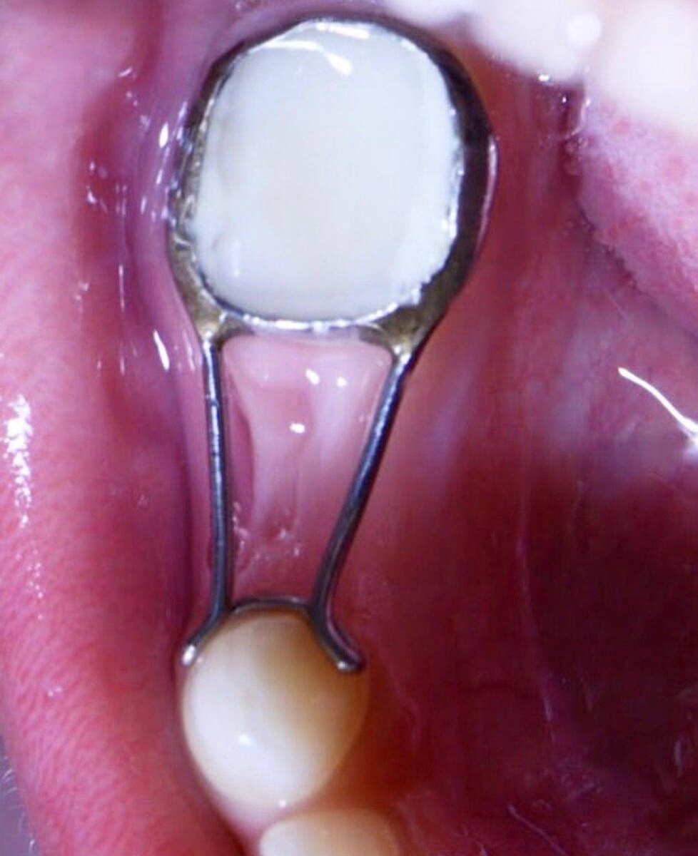 сохранитель места "кольцо-петля"