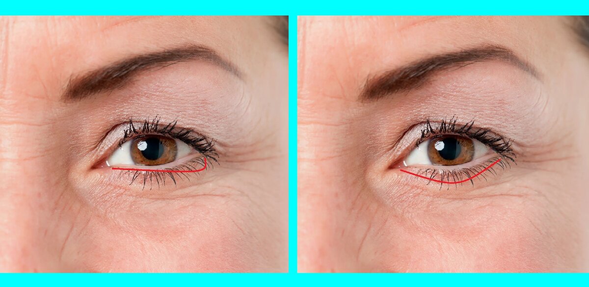 Иногда подобное строение век/глаз бывает врожденным