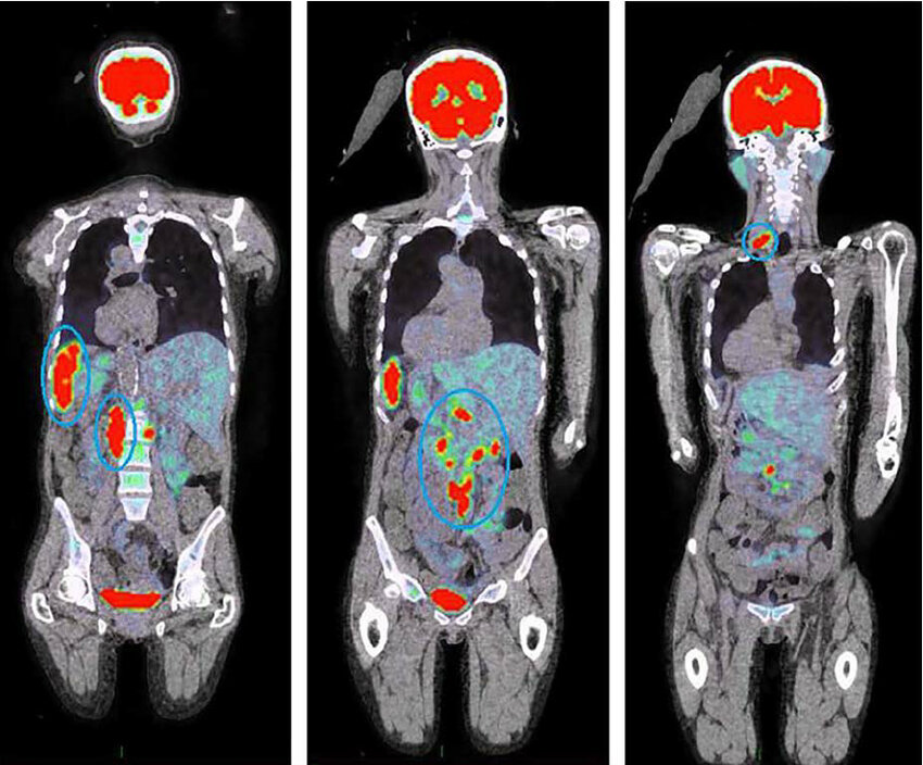 Снимок органов человека при ПЭТ КТ. Фото с сайта https://prohz.ru/news/dieta-pet-kt-chto-mozhno/