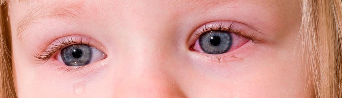 От коньюктивита 3 года. Аденовирусный конъюнктивит глаз. Красные глаза у ребенка конъюнктивит. Аллергический конъюнктивит у младенца.