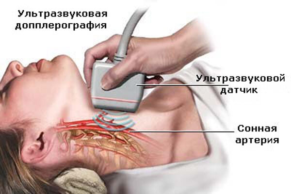 УЗИ сосудов шеи и головы (УЗИ БЦА)