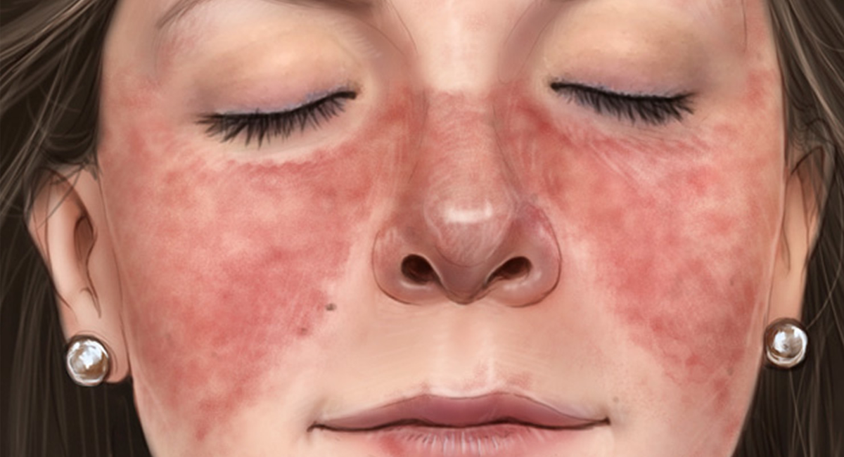Симптом "бабочки" при Волчанке. Изображение взято из открытых источников.