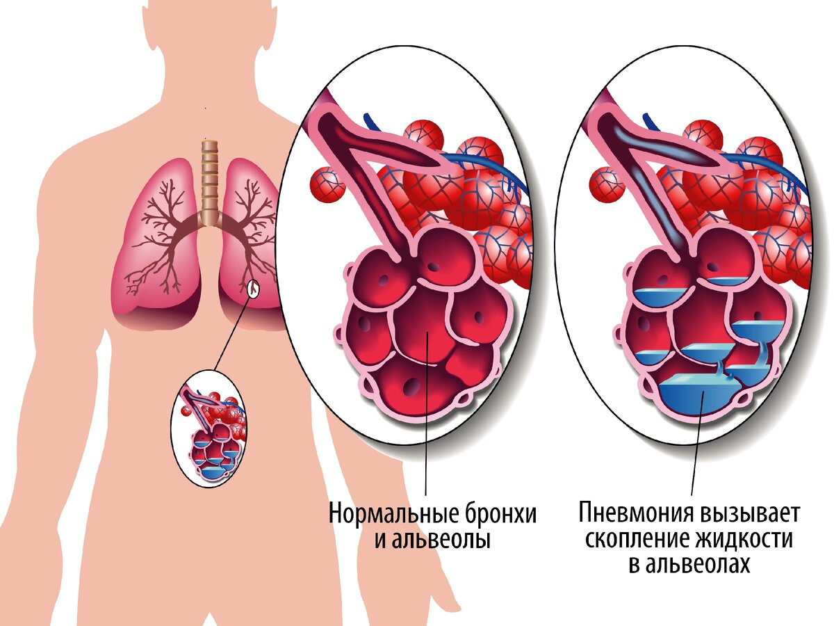 Пневмония