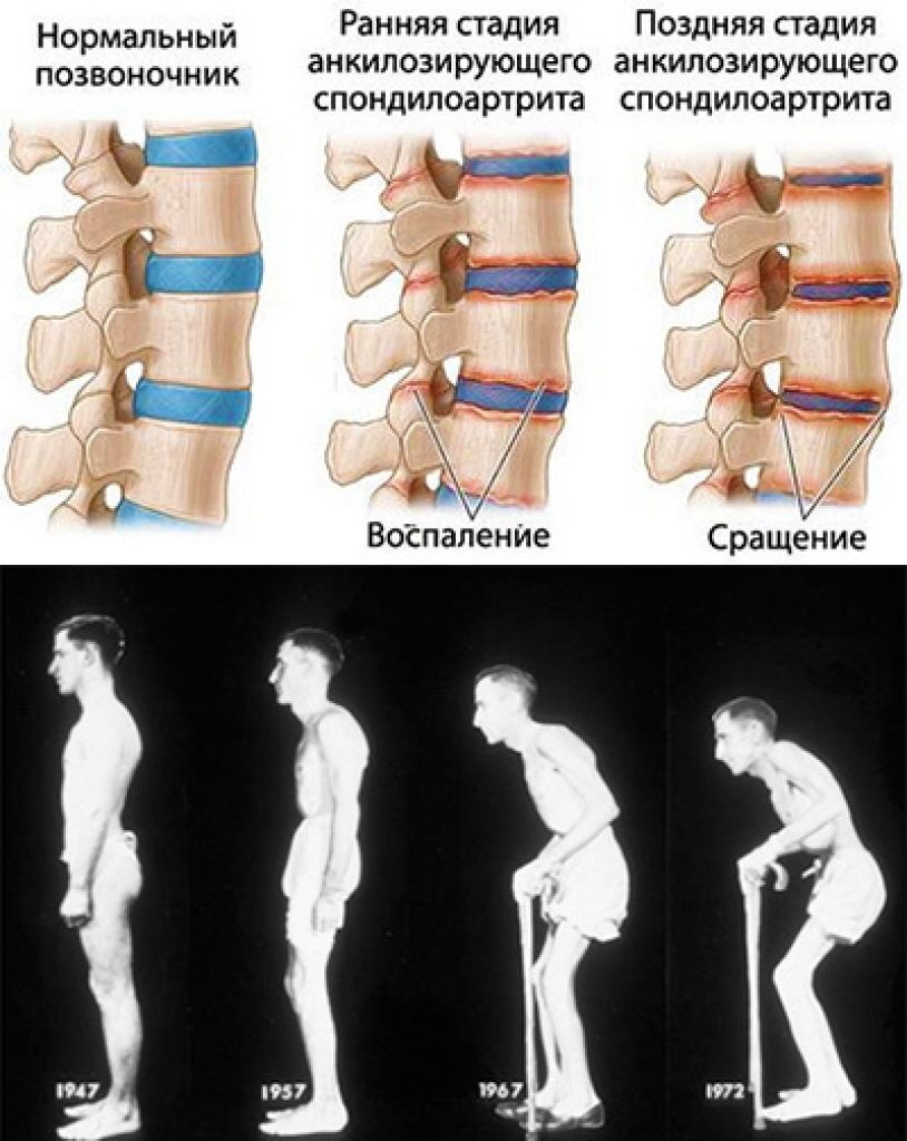 Спондилез какой врач