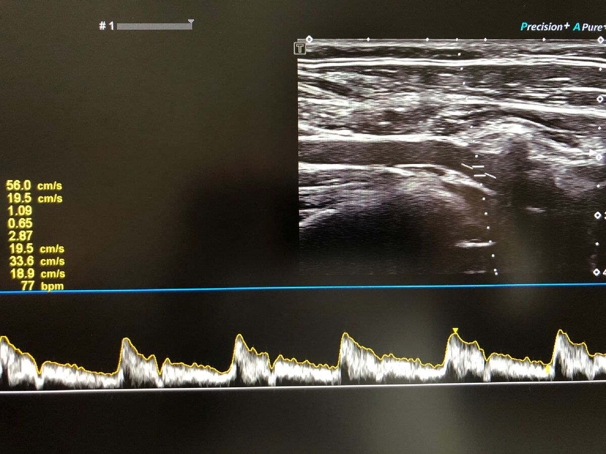 1️⃣Плечеголовной ствол (truncus brahiocephalicus, ПГС) - непарный, крупный, сравнительно короткий сосуд.
✅Отходит от дуги аорты вверх и вправо.
✅Позади рукоятки грудины и начала грудино-подъязычной и грудино-щитовидной мышц, а также левой плечеголовной вены и вилочковой железы он разделяется на правую подключичную артерию (ПкА) и правую общую сонную артерию (ОСА). 
2️⃣Правая подключичная артерия (a. subclavia dextra)
✅Отдаёт артерии к голове, шее, плечевому поясу и верхней конечности одноимённой стороны.
✅Начальная часть артерии огибает верхушку правого лёгкого и отдаёт свою первую ветвь - позвоночную артерию.

3️⃣Позвоночная артерия (a. vertebralis, ПА)
✅отходит от верхней полуокружности ПкА и следует вверх, латеральнее и позади ОСА до отверстия поперечного отростка VI шейного позвонка.
✅Далее артерия проходит до II шейного позвонка в костно-фиброзном канале, образованном отверстиями поперечных отростков и связками.

К нам обратился пациент, мужчина, 1973 г.р., с гиперлипидемией, без жалоб. При ДС БЦА справа выявлено:
🔺отхождение ПГС от дуги аорты,
🔺деление ПГС на ОСА и ПкА,
🔺аномальное отхождение ПА от дистального отдела ПГС/устья ОСА, её задне-медиальное расположение относительно ОСА и аномальное вхождение в позвоночный канал на уровне 5-го шейного позвонка, с незначительным усилением скоростных параметров потока в сегменте V1 (без нарушения спектральных характеристик). 

В связи с этим возникает ряд вопросов:
❓Может ли ПГС быть ничем иным, как проксимальным отделом ПкА, отходящей от дуги аорты, а ОСА и ПА в свою очередь отходят от ПкА, поменявшись местами (маловероятно),
❓Может ли ПГС располагаться более горизонтально, а ОСА отходить от ПГС под прямым или острым углом (возможно),
❓Отходит ли ПА от дистального отдела ПГС или от устья ОСА (неясно).

❗️Отправлен на дообследование (КТ).
