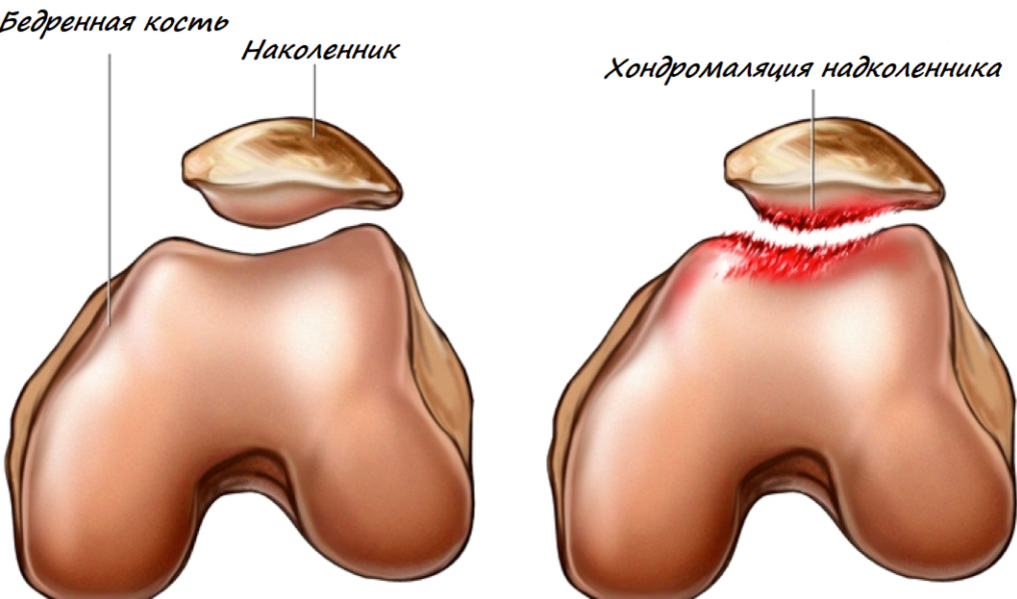 Латеральная фасетка