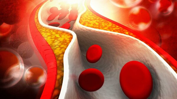 Три продукта, которые защищают сосуды от холестериновых бляшек