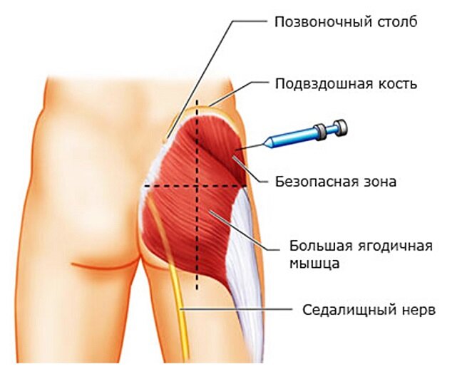 Воспаление седалищного нерва