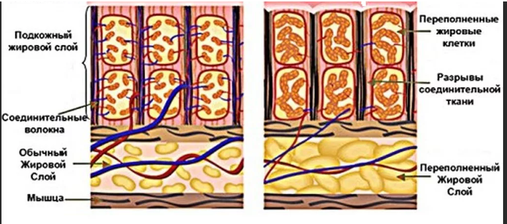 Подкожная клетчатка, удерживая излишек жидкости, затрудняет работу сосудов