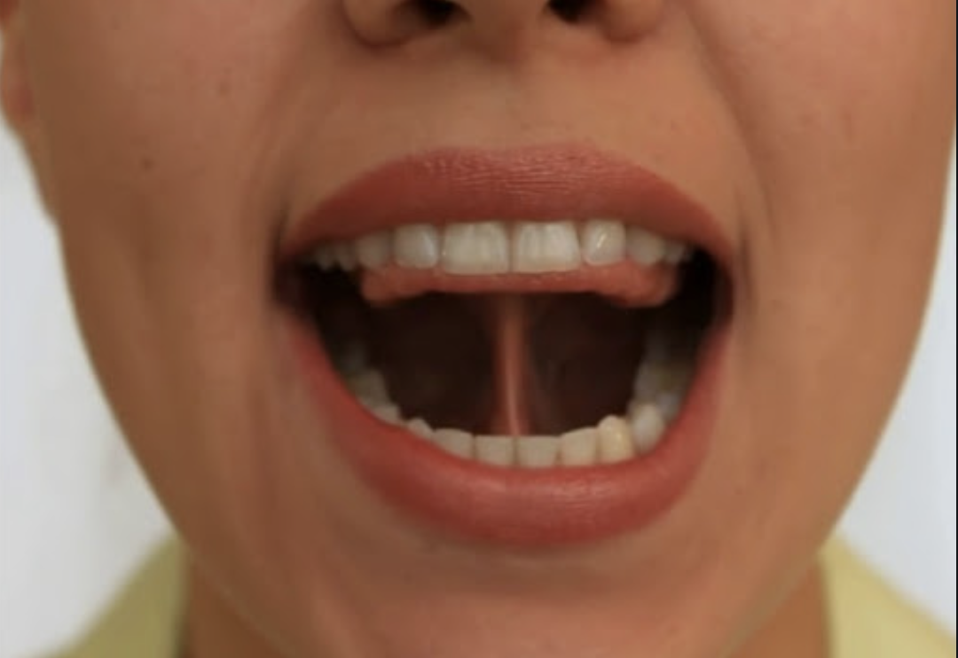 "Уздечка". При упражнении "Грибочек" (фото с сайта "Изумрудный город")