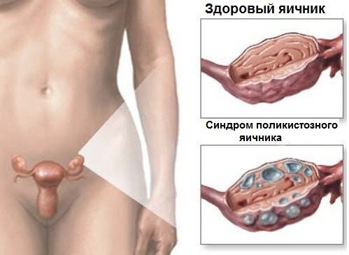 Синдром поликистозных яичников