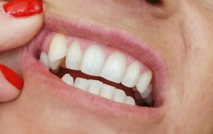 зубы в 2 ряда фото