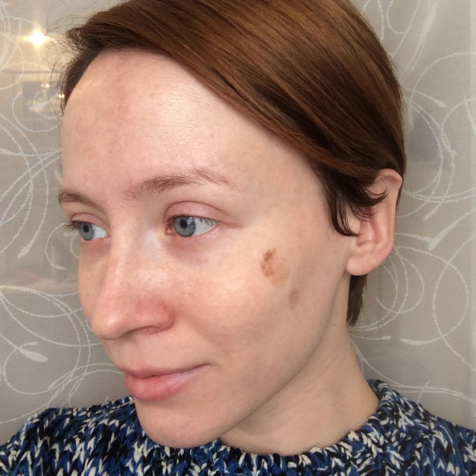 Мелазма - пятно, которое сложно замаскировать и осветлить