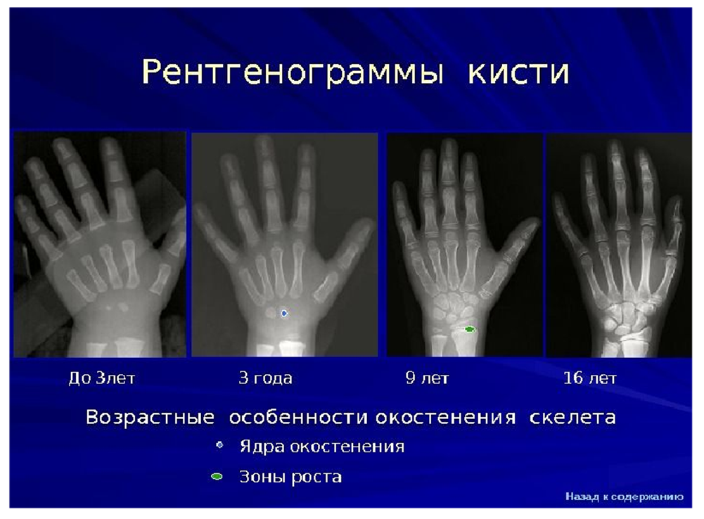 Определение "костного возраста" по рентгену запястья