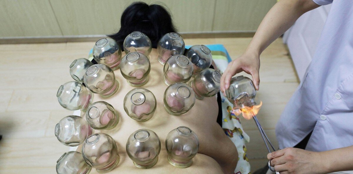банки медицинские стеклянные на спину. банки медицинские стеклянные на спину. медицинский банки на спину. постановка медицинских банок на спину. банки медицинские стеклянные на спину.
