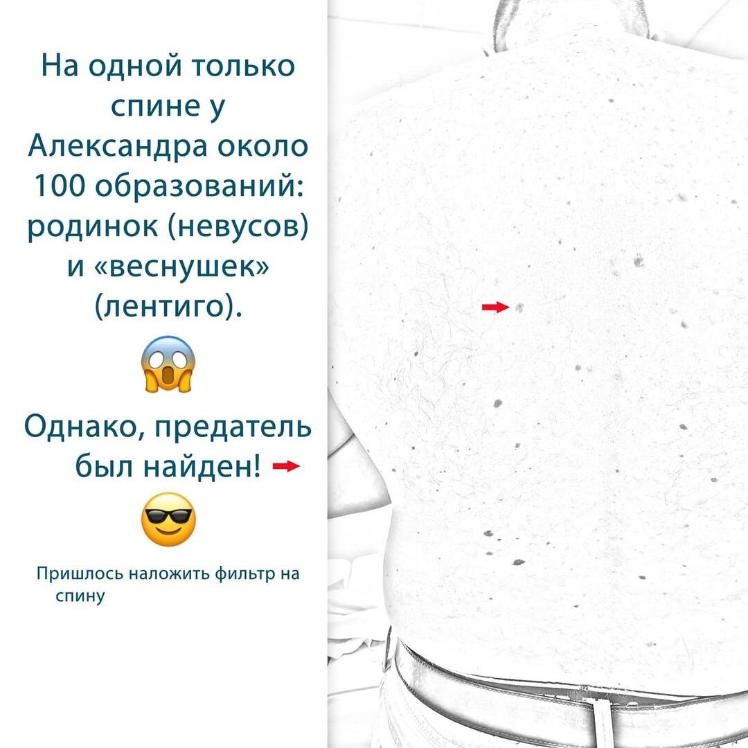 У Александра с детства было много родинок. Тогда же он много раз сгорал на солнце. С тех пор, руки и спина покрыты множеством пигментных пятнышек, которые Александр называет веснушками.-2