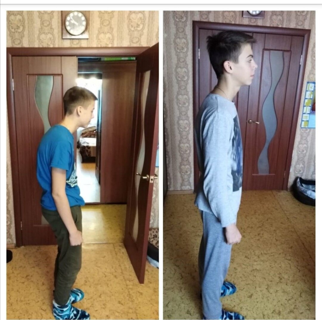 Исправление кифоза и сколиоза